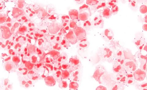 Paraíba registra 38 casos e 10 mortes por meningite em 2022